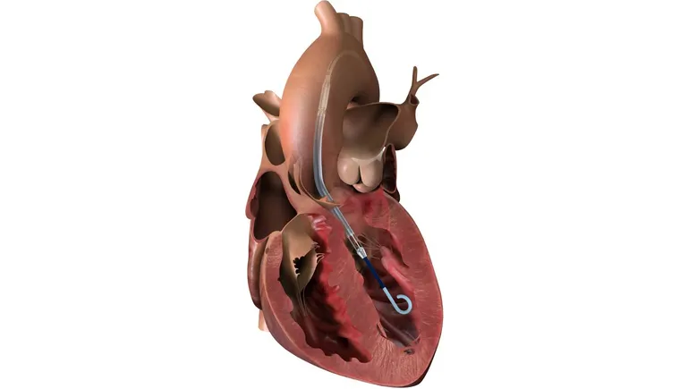 Johnson & Johnson recalls Impella heart pumps: one patient death reported