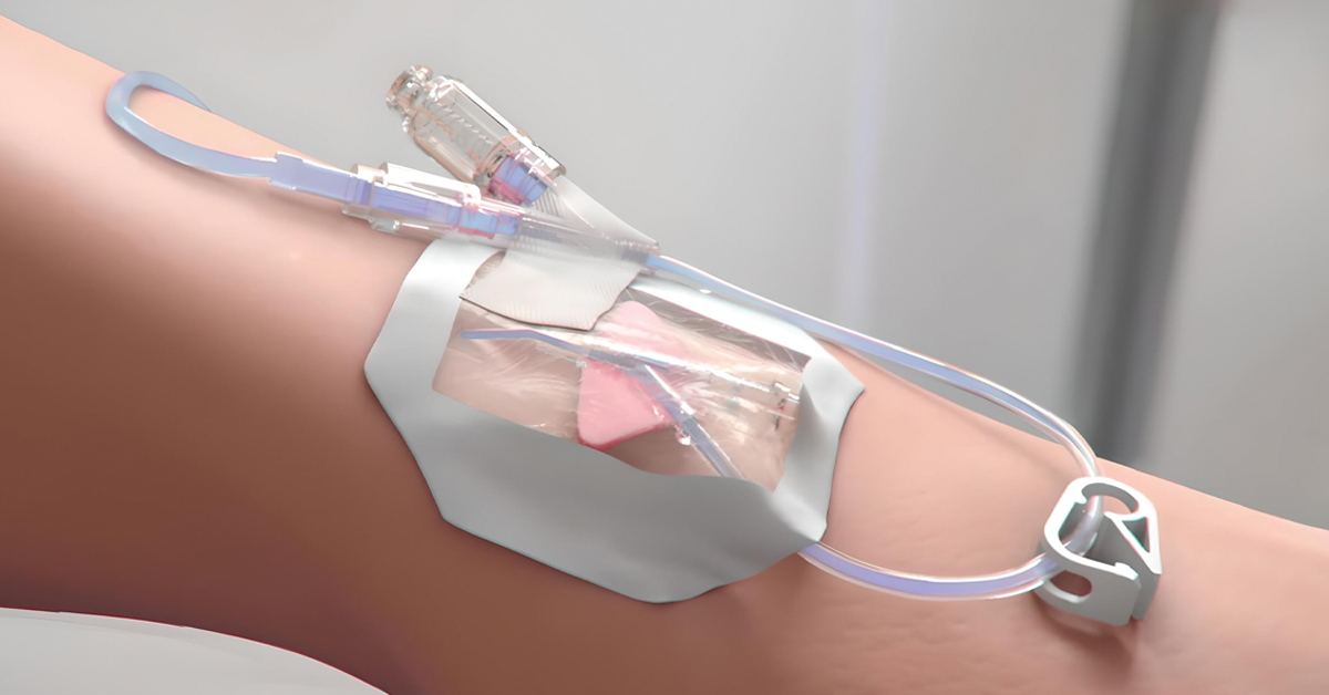 MedSource Labs推出ClearSafe Comfort&reg;密闭系统，完善外周静脉导管全产品线